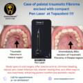 Excision of Palatal Traumatic Fibroma with Laser