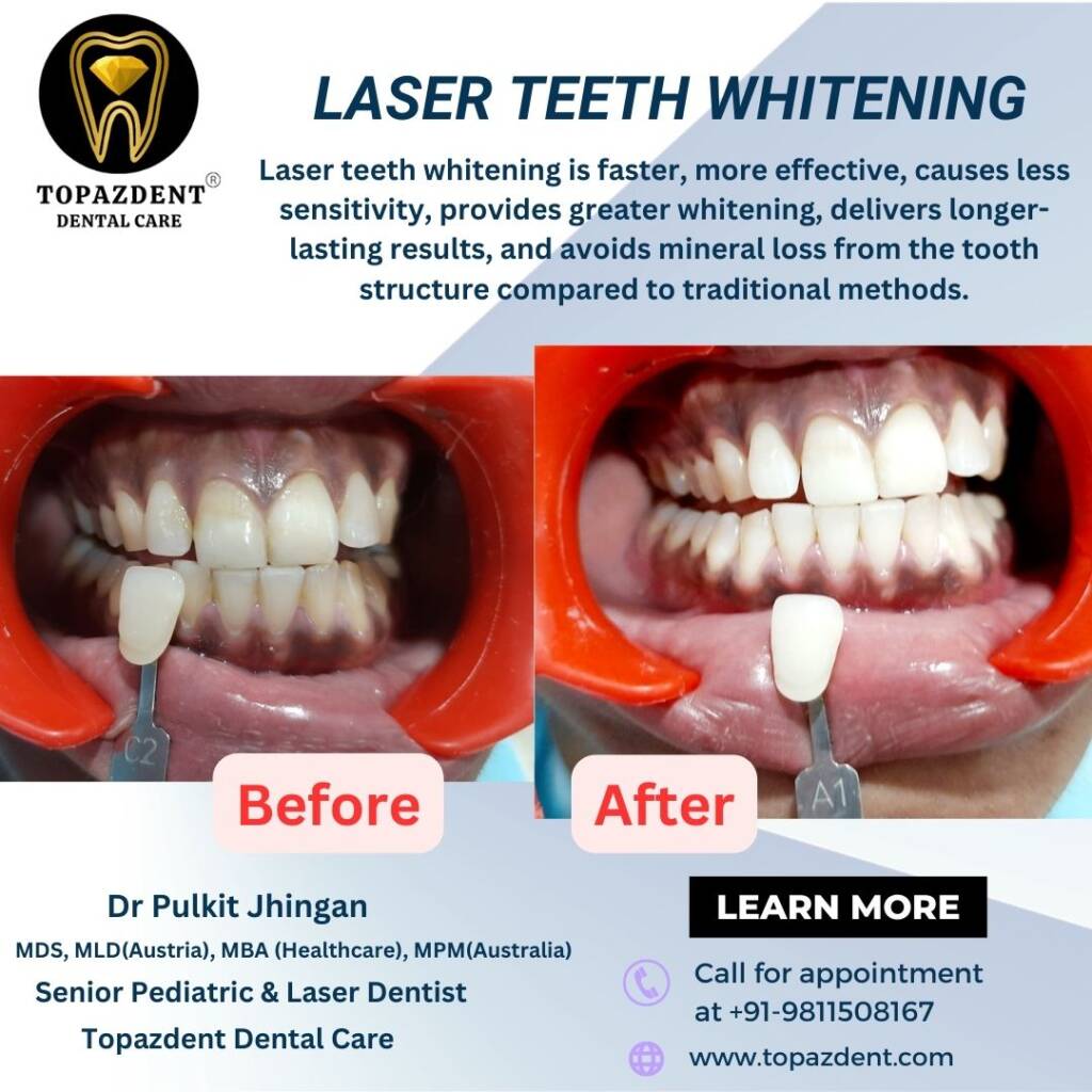 LaserTeethWhitening - Topazdent Dental Care